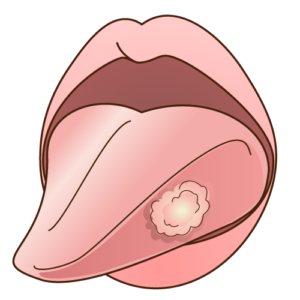 口腔癌や舌癌は早急に大学病院で診察をする