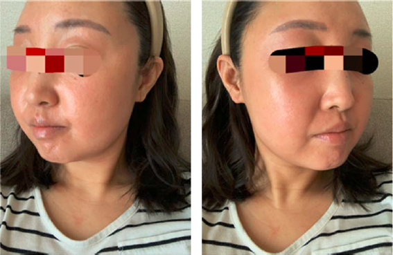 顔の腫れや炎症が起きる前日の皮膚の様子